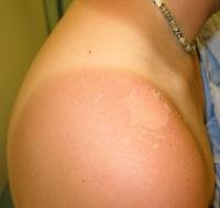 Sunburn - Causes, Symptoms & Remedy
